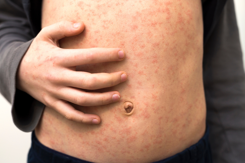 Autoridades confirman cuatro casos importados de sarampión en Colombia